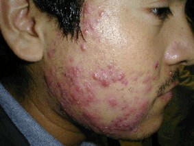 natural acne solutions